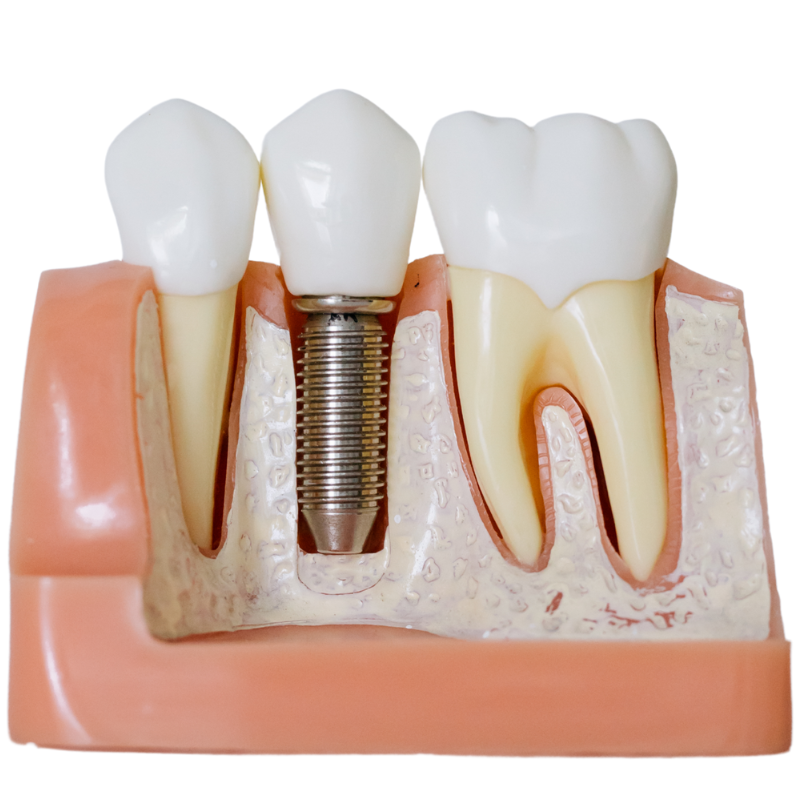 implantes dentales en sant mateu