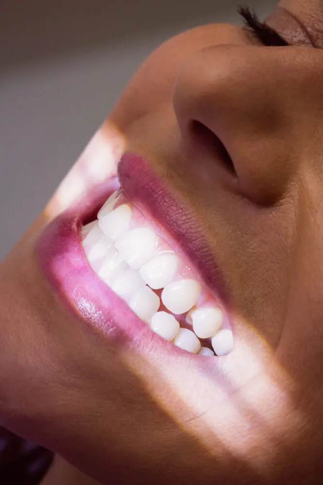 nuestras carillas dentales en sant mateu